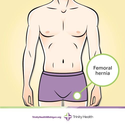 Femoral hernia location graphic