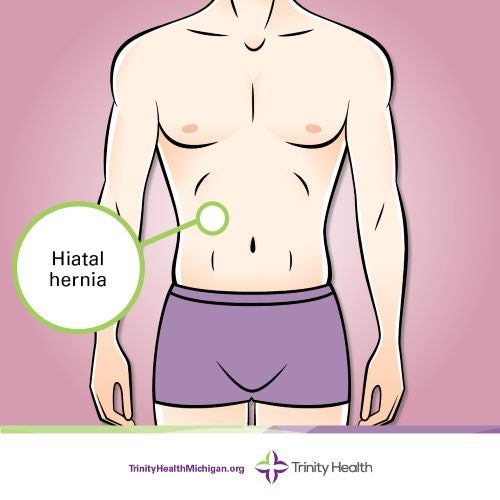 Hiatal hernia location graphic