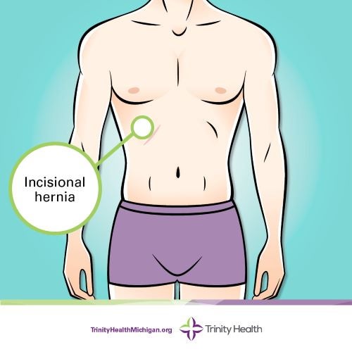 Incisional hernia location graphic