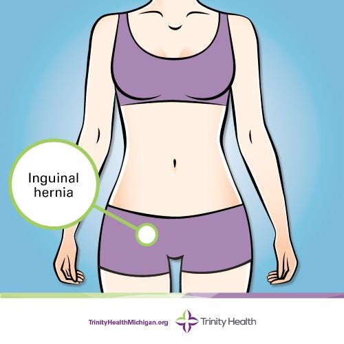 Inguinal hernia location graphic