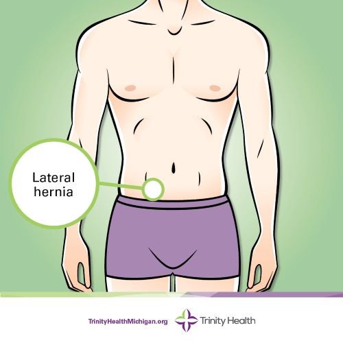lateral hernia location graphic
