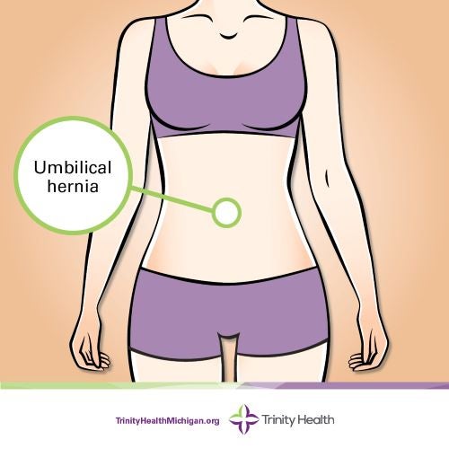 Umbilical hernia location graphic