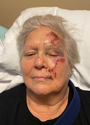 Fran, a former inpatient rehabilitation patient at Trinity Health Ann Arbor, is photographed inside the hospital following a serious fall that resulted in multiple fractures and a significant loss of mobility.