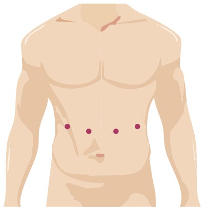 Robotic Surgery Incision