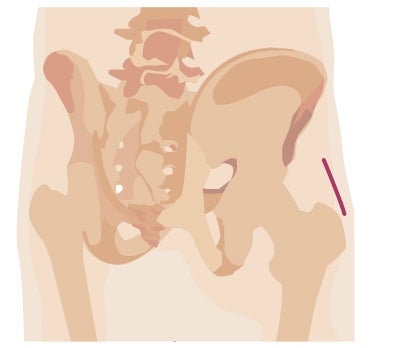 Robotic surgery incision from hip surgery