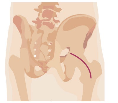 Traditional surgery incision from hip surgery