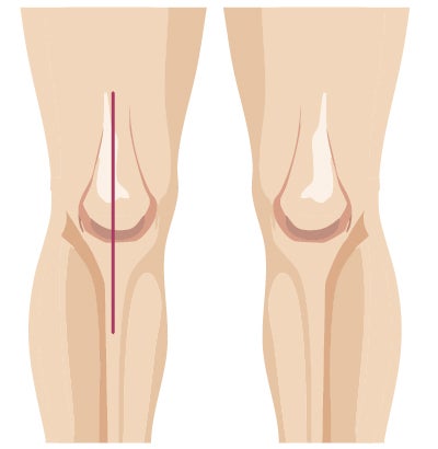 Traditional surgery incision from knee surgery